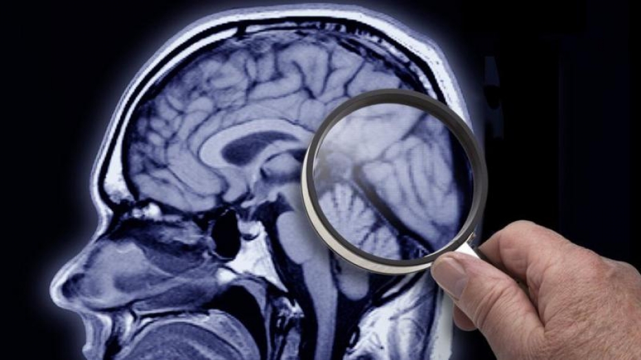 Demans ve Alzheimer: Belirtileri neler, hangi tedaviler uygulanıyor?