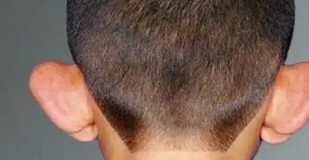 Kepçe kulak  (belirgin kulak)  kader değil!