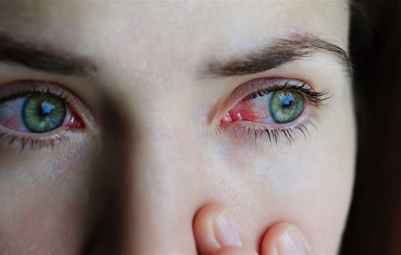 Vaka sayıları gittikçe artıyor!  Gözlerdeki yeni salgının kaynağı: ADENOVİRÜS