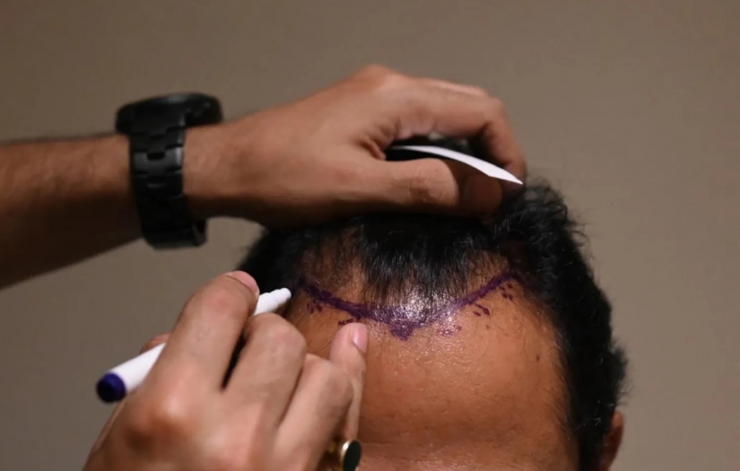 Çığır açan çalışmayla kelliğin yeni tedavileri mümkün