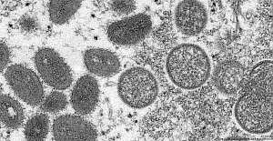 Sağlık Bakanı Koca: "Bir hastamızda maymun çiçeği hastalığı tespit edildi"