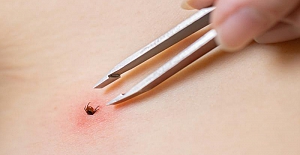 Yaz geldi kene vakaları arttı