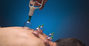 4 bin yıllık tıp geleneği: Kupa tedavisi