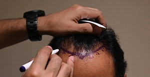 Çığır açan çalışmayla kelliğin yeni tedavileri mümkün